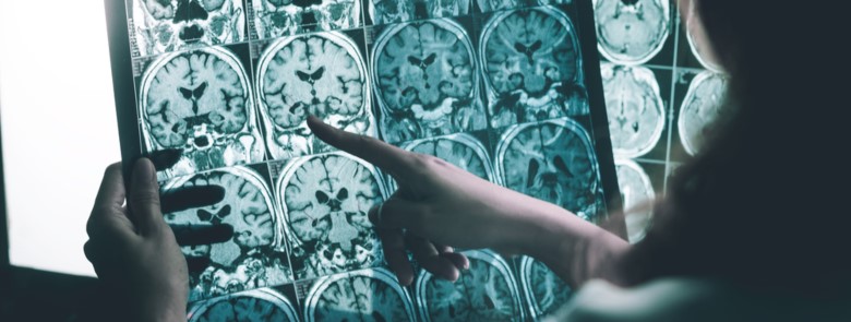 Alzheimer: terapia celular pode melhorar funções cerebrais